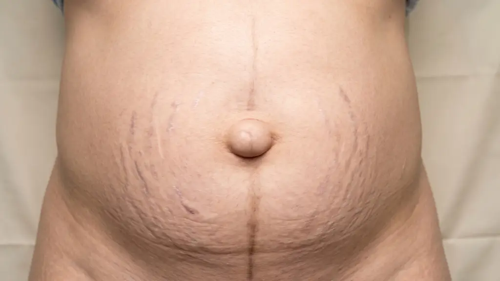 Primer plano detallado de la anatomía de una hernia umbilical en un abdomen flácido posparto