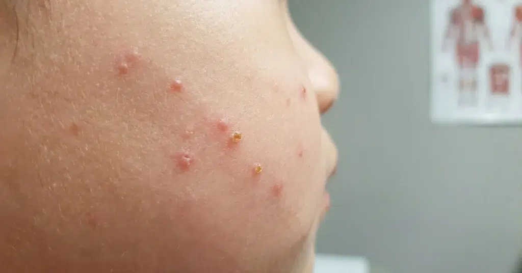 impétigo en niños fotos primeros síntomas costras amarillentas alrededor de la boca